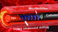 Vortex ultrasound breaks down blood clots in the brain